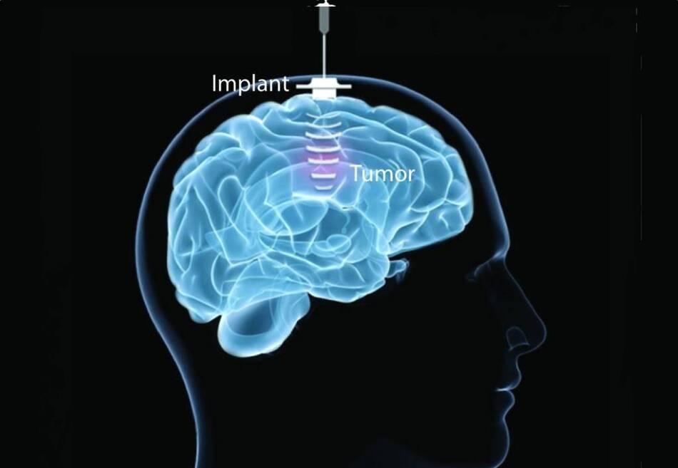 Carthera lève 42 M€ pour développer SonoCloud